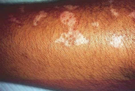 Chloroquine Induced Vitiligo Like Depigmentation Journal Of The