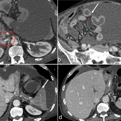 Contrast Enhanced Ct Images In The Portal Venous Phase A And B And