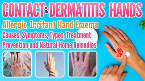 Contact Dermatitis Hands Types Causes Symptoms Treatment Home