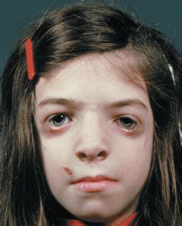 Two of the children suffered from franceschetti syndrome and one child from goldenhar's syndrome. mandibulofacial dysostosis