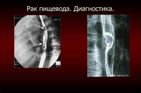 Дивертикулы диета и лечение