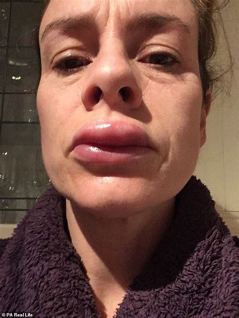 Mother Suffers Allergic Reaction On Lips To £60 Teeth Whitening Kit