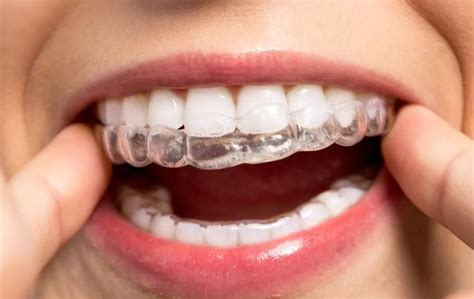 The Role Of Invisalign Attachments In Orthodontic Treatment