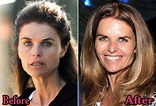 Maria Shriver Facelift Before and After Photos | Top Piercings