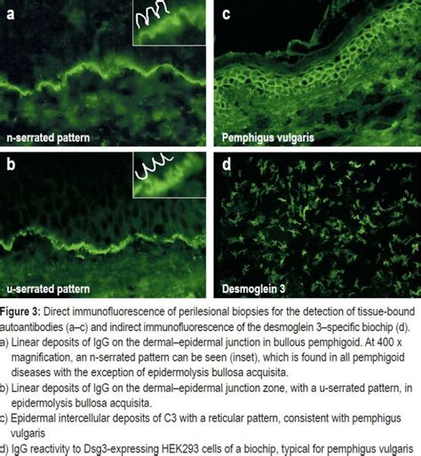 Epidermolysis Bullosa Acquisita Immunofluorescence