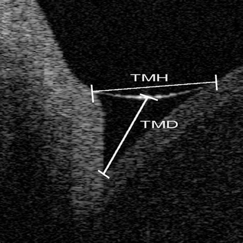 4 Third Degree Tear Grade 3c With Arrows Demonstrating Retraction Of