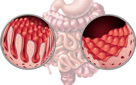 Coeliac Disease Causes Symptoms And Side Effects Gastroenterology