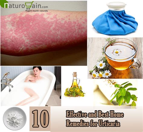 Topical application of apple cider vinegar stops bacterial or fungal growth on the skin and help in treating the skin rashes. 10 Effective and Best Home Remedies for Urticaria