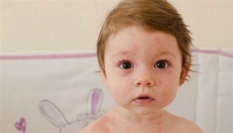 درمان خانگی عرق سوز شدن نوزاد بلاگ بورسیکا