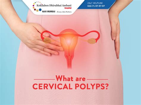 What Are Cervical Polyps