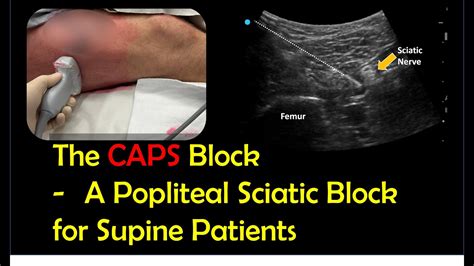 Lateral Popliteal Sciatic Block For Supine Patients Caps Block Youtube
