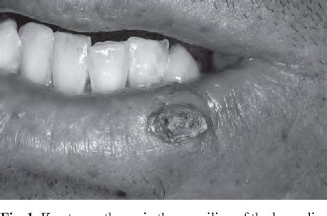 Figure 1 From Keratoacanthoma In The Inferior Lip Of An