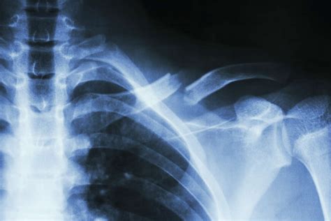Collarbone Pain After Car Accident