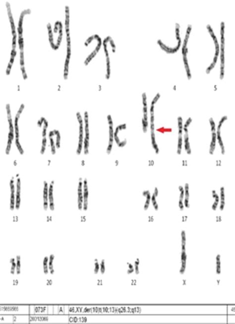 Patau Syndrome By Reciprocal Translocation Between Chromosomes 10 And 13