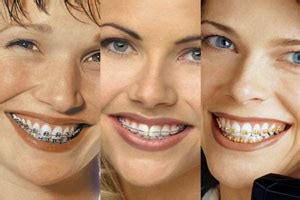 Die kosten für unsichtbare zahnspangen liegen deutlich über denen der losen und festen. Брекет системы | Стоматологическая поликлиника №28