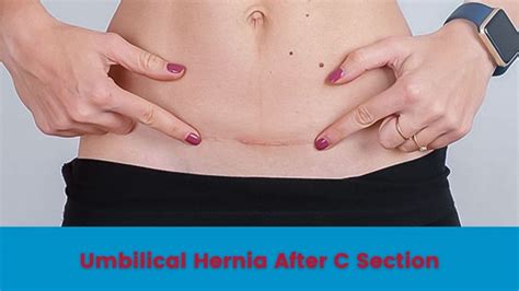 Umbilical Hernia After C Section Cesarean Delivery Sahyadri Hospital