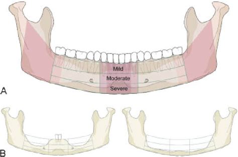 Illustration Of Mandibular Edentulism And Atrophy A Atrophy Grid