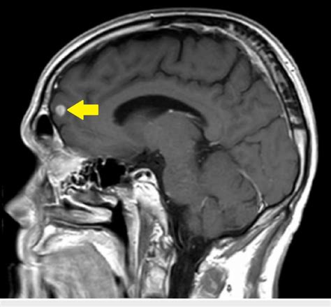 Left Frontal Lobe Metastasis Pre Treatment Sagittal Brain Magnetic