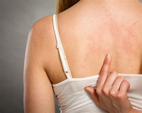 How To Identify Hiv Rashes In The Early Stage Anaedoonline