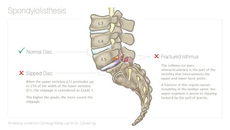 Treating Low Back Pain Spondylolisthesis Hong Kong Spine Centre
