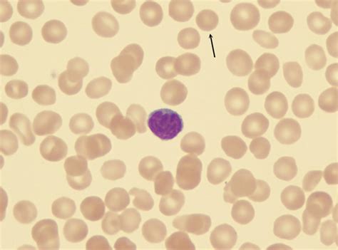 Spherocytes are small cells that lack a central pallor and appear darkly stained. Hereditary spherocytosis — Medlibes: Online Medical Library