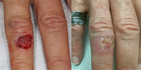 Body Hand Reconstruction After Skin Cancer Excision Skin Cancer And