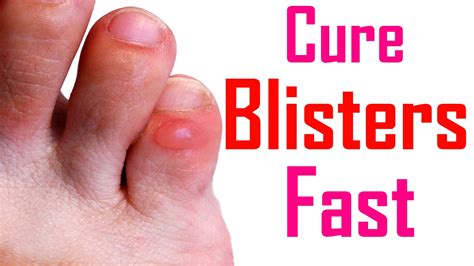 home remedies to treat and get rid of blisters how to get rid of blisters youtube