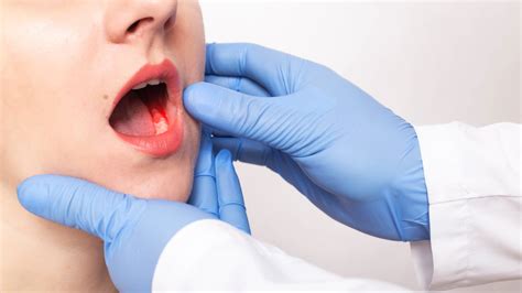 Oral Cancer Treatment In Delhi Everything You Need To Know