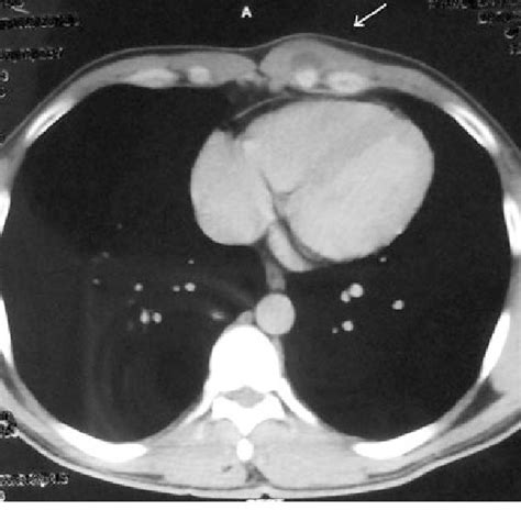 A Clinical Photograph Of The Patient Shows The 5 9 3 Cm Cystic Swelling