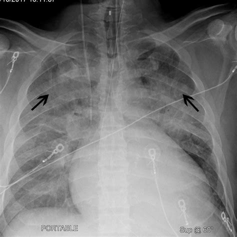 Image Chest X Ray Of A Patient With Cardiomegaly And Cephalization