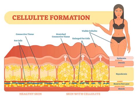 Does Collagen Help With Cellulite Why Science Says It Works