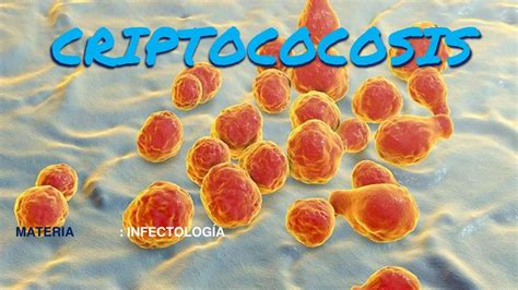 Criptococosis Criptococosis Criptococosis Udocz