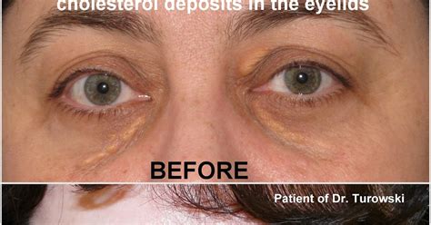 New Horizons Plastic Surgery Xanthelasma Removal Cholesterol