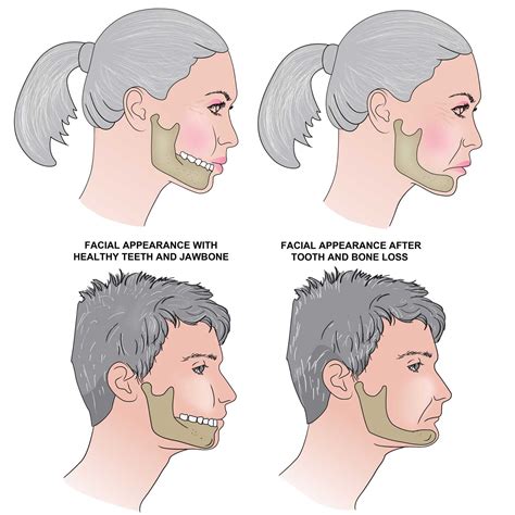 The Consequences Of Tooth Loss On Your Jawline And Facial Appearance