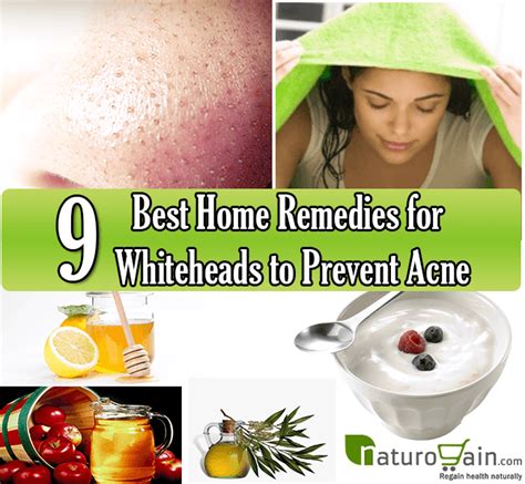 9 Best Home Remedies For Whiteheads To Prevent Acne