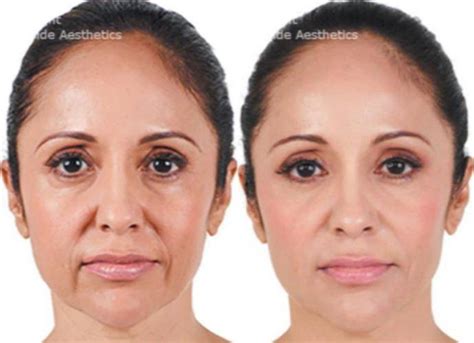 Juvederm For Lower Face By Dr Rivkin Los Angeles California Facial