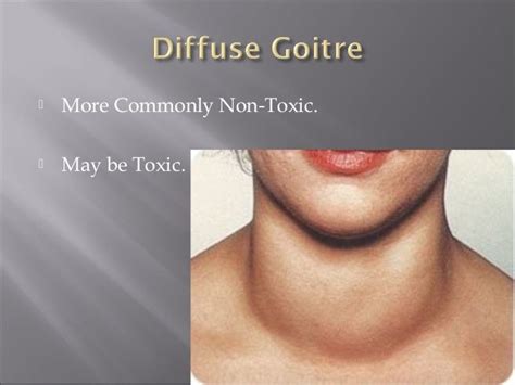 Diffuse Toxic And Endemic Goiter
