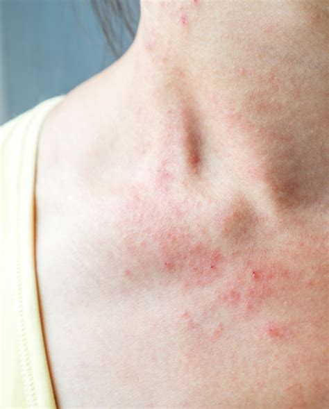 Atopic Dermatitis Eczema Mesa Az Sagebrush Dermatology