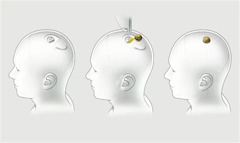 La Société Delon Musk Neuralink Autorisée à Tester Ses Implants