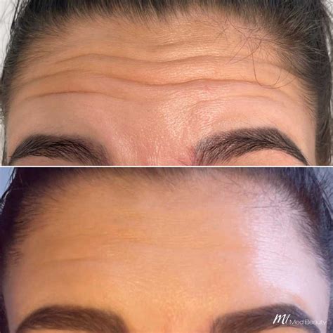 Forehead Lines Anti Wrinkle Treatment M1 Med Beauty Australia