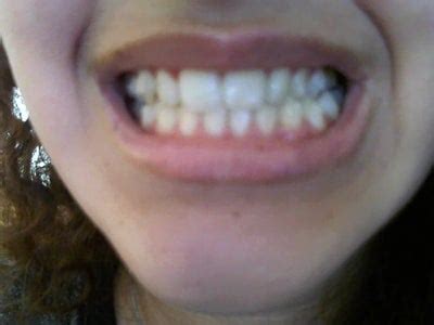 The costs include all the brackets, wires, connecting elastic, or invisalign aligners, and the. How Long Would I Have Braces in for my Crossbite & Slight ...