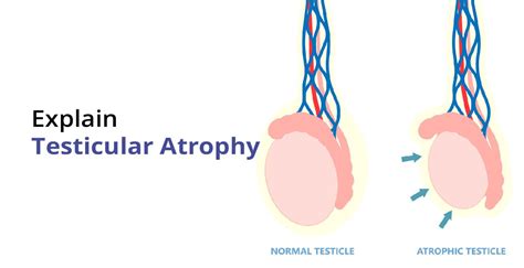 Testicular Atrophy Symptoms Causes Treatment Birla Fertility Ivf