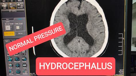 Normal Pressure Hydrocephalus CT Scan Brain YouTube