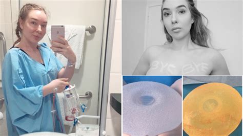 Breast Implant Illness Perth Woman Opens Up About Her Struggle After
