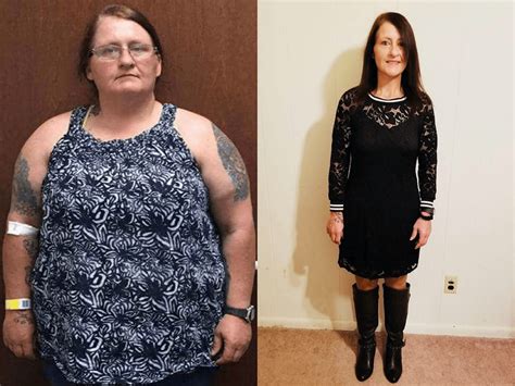 gastric bypass before and after pictures