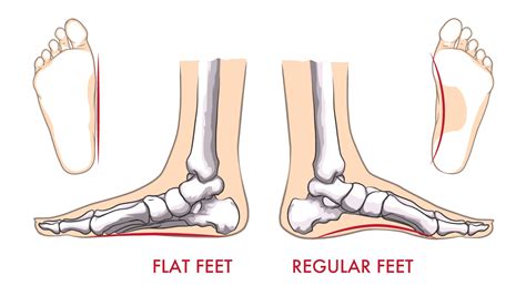 Flat Feet Az Feet Fixers