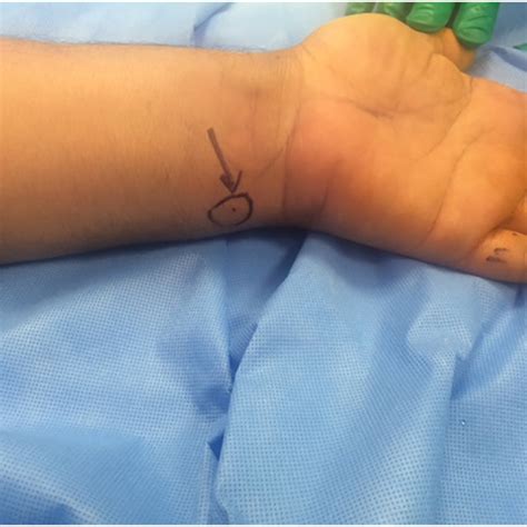 Partial Closure Of The Fasciotomy Wound Two Days Later Download