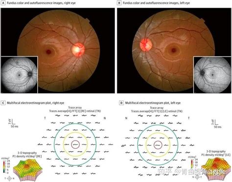 文献分享案例报告 重复低强度红光照射后的视网膜损伤 知乎
