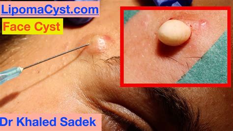 Massive Face Cyst Dr Khaled Sadek Lipomacyst Com Youtube