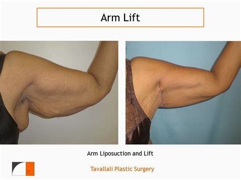 Medical Treatment Pictures For Better Understanding Arm Lift Surgery
